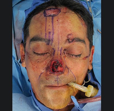 Nasal Reconstruction Before & After Gallery - Patient 122909286 - Image 1