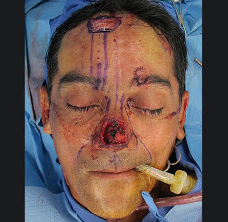 Nasal Reconstruction Before & After Gallery - Patient 122909286 - Image 1