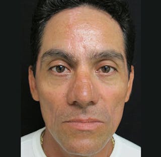 Nasal Reconstruction Before & After Gallery - Patient 122909286 - Image 2