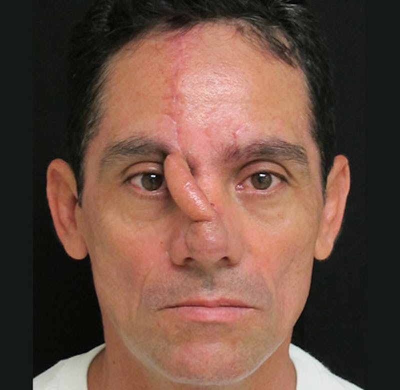 Nasal Reconstruction Before & After Gallery - Patient 122909286 - Image 3