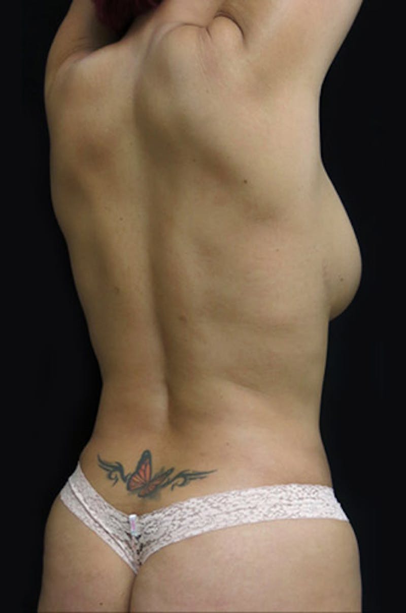 Breast Reconstruction Before & After Gallery - Patient 122909285 - Image 18