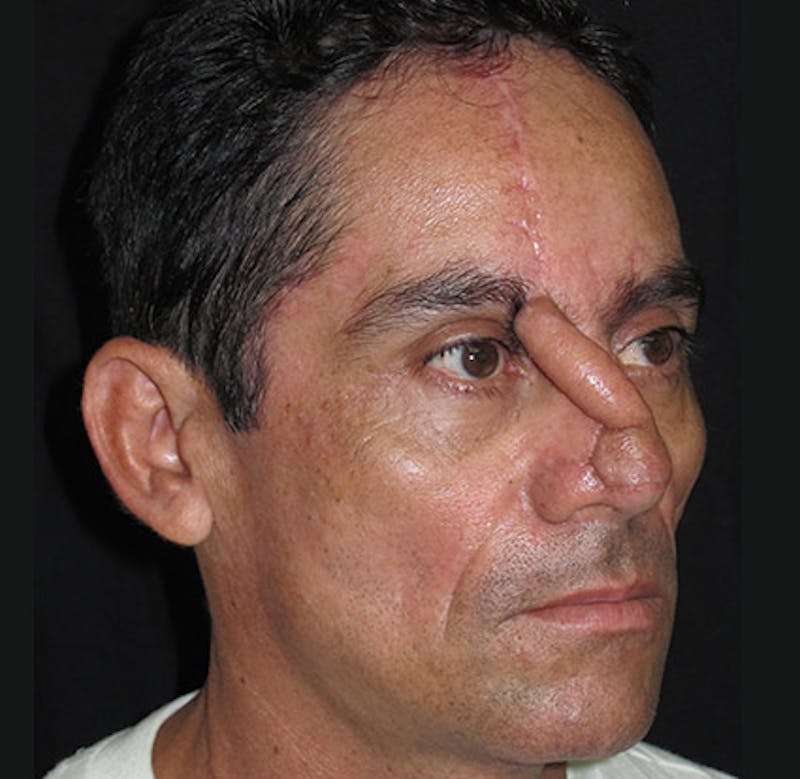 Nasal Reconstruction Before & After Gallery - Patient 122909286 - Image 5