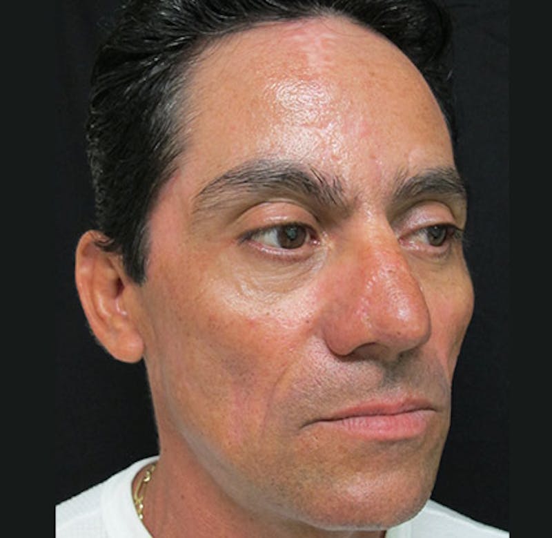 Nasal Reconstruction Before & After Gallery - Patient 122909286 - Image 6