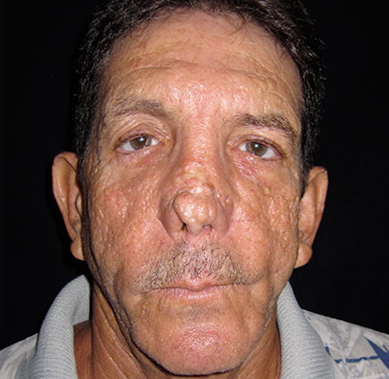 Nasal Reconstruction Before & After Gallery - Patient 122909289 - Image 1