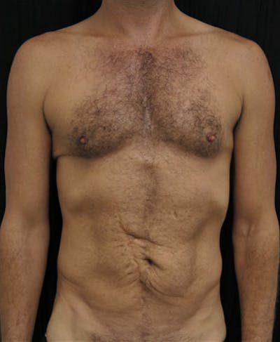 Hernia Repair Abdominal Wall Before & After Gallery - Patient 122909287 - Image 1