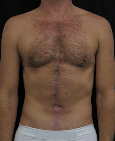 Hernia Repair Abdominal Wall Before & After Gallery - Patient 122909287 - Image 2