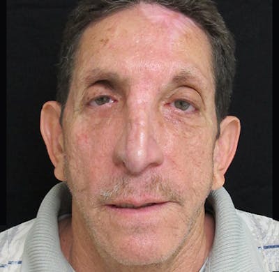 Nasal Reconstruction Before & After Gallery - Patient 122909289 - Image 2