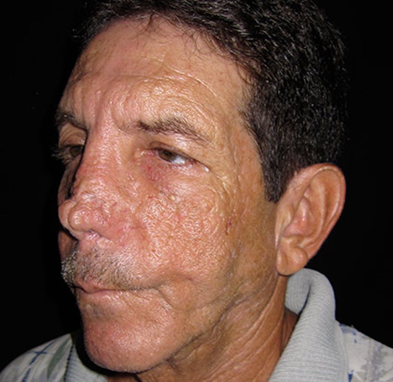 Nasal Reconstruction Before & After Gallery - Patient 122909289 - Image 3