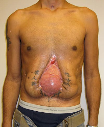 Hernia Repair Abdominal Wall Before & After Gallery - Patient 122909293 - Image 1