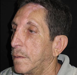 Nasal Reconstruction Before & After Gallery - Patient 122909289 - Image 4