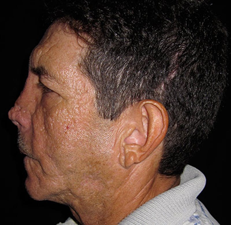 Nasal Reconstruction Before & After Gallery - Patient 122909289 - Image 5