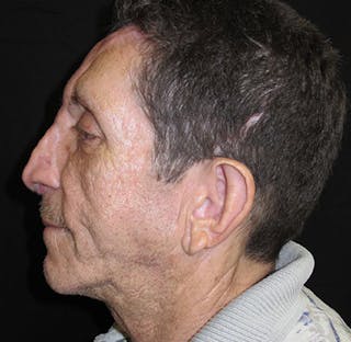 Nasal Reconstruction Before & After Gallery - Patient 122909289 - Image 6
