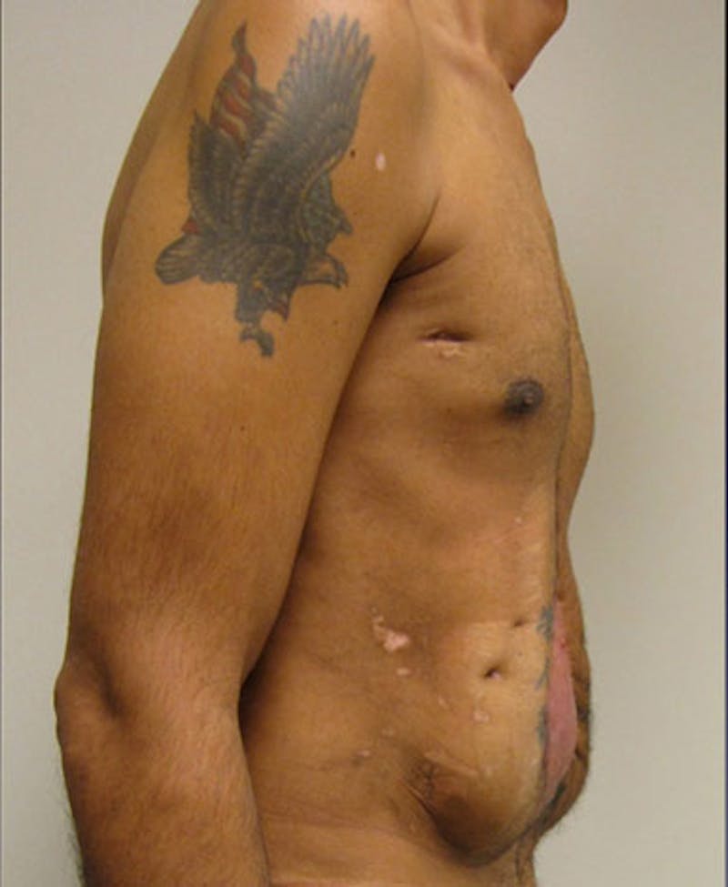 Hernia Repair Abdominal Wall Before & After Gallery - Patient 122909293 - Image 5