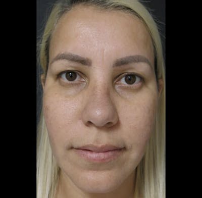 Nasal Reconstruction Before & After Gallery - Patient 122909294 - Image 2