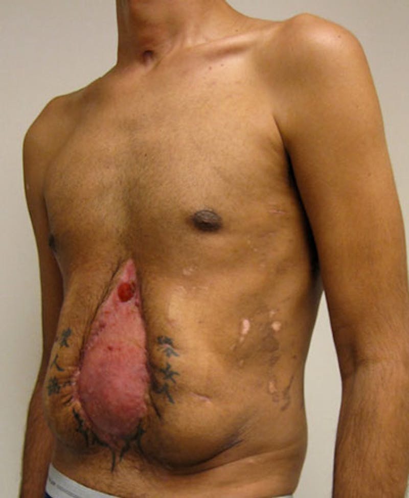 Hernia Repair Abdominal Wall Before & After Gallery - Patient 122909293 - Image 7
