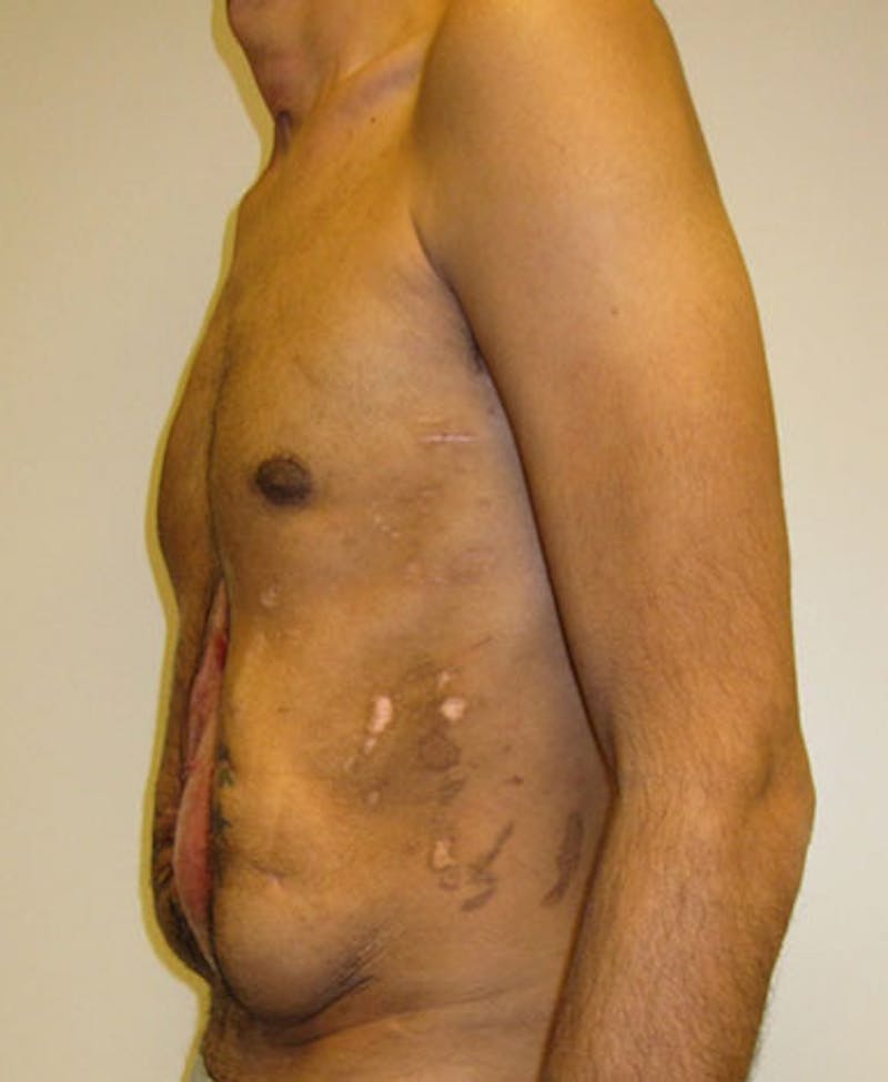 Hernia Repair Abdominal Wall Before & After Gallery - Patient 122909293 - Image 9