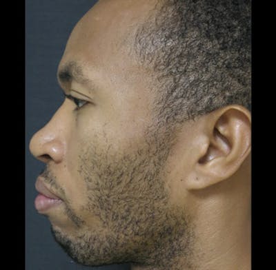 Nasal Reconstruction Before & After Gallery - Patient 122909299 - Image 1