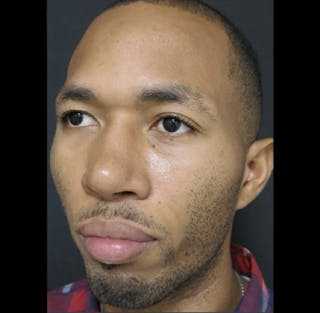 Nasal Reconstruction Before & After Gallery - Patient 122909299 - Image 10