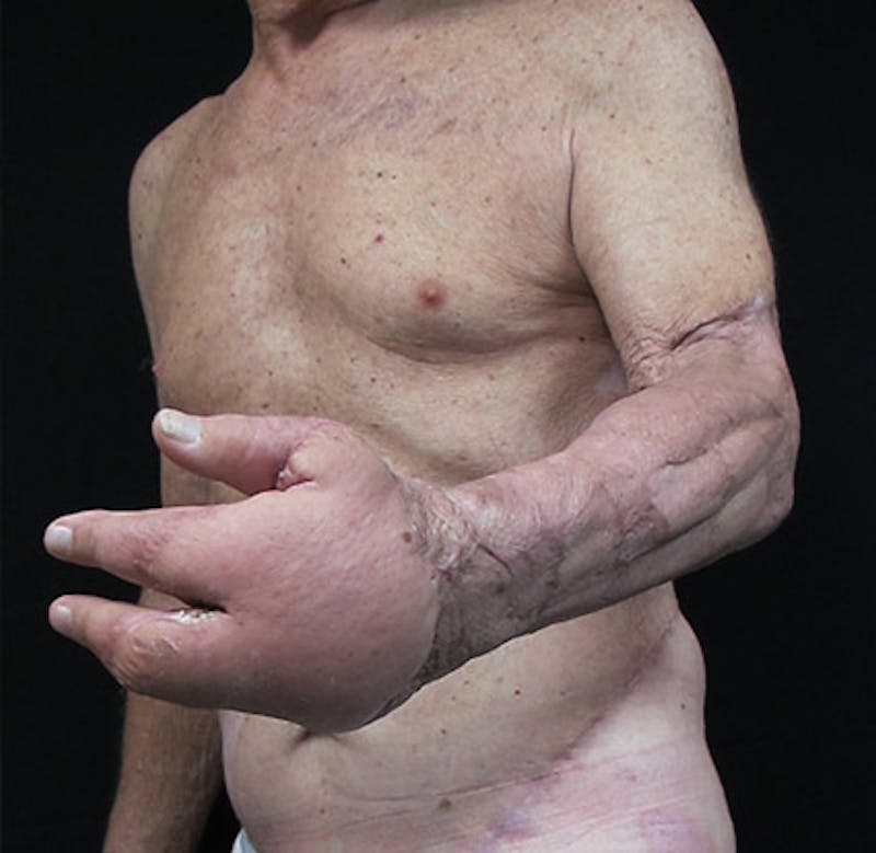 Hand Repair/Reconstruction Before & After Gallery - Patient 122909300 - Image 2
