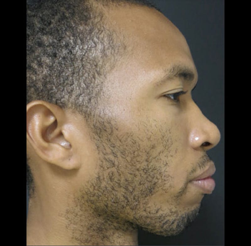 Nasal Reconstruction Before & After Gallery - Patient 122909299 - Image 11