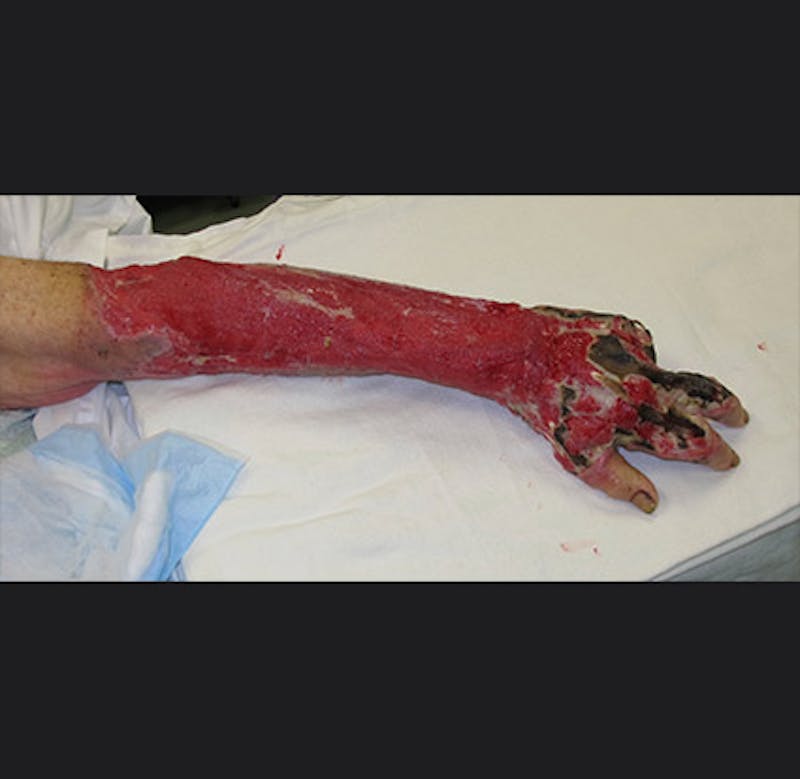 Hand Repair/Reconstruction Before & After Gallery - Patient 122909300 - Image 3