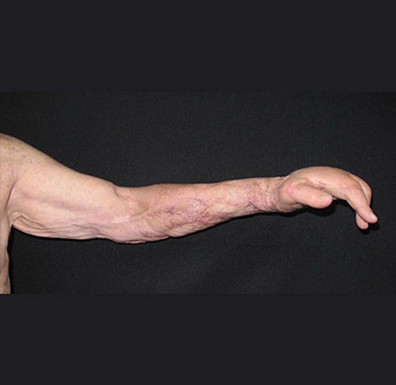 Hand Repair/Reconstruction Before & After Gallery - Patient 122909300 - Image 4