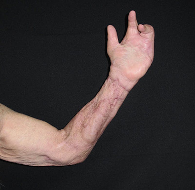 Hand Repair/Reconstruction Before & After Gallery - Patient 122909300 - Image 6