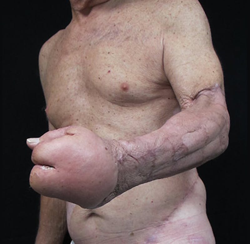 Hand Repair/Reconstruction Before & After Gallery - Patient 122909300 - Image 7