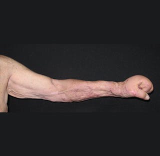 Hand Repair/Reconstruction Before & After Gallery - Patient 122909300 - Image 8
