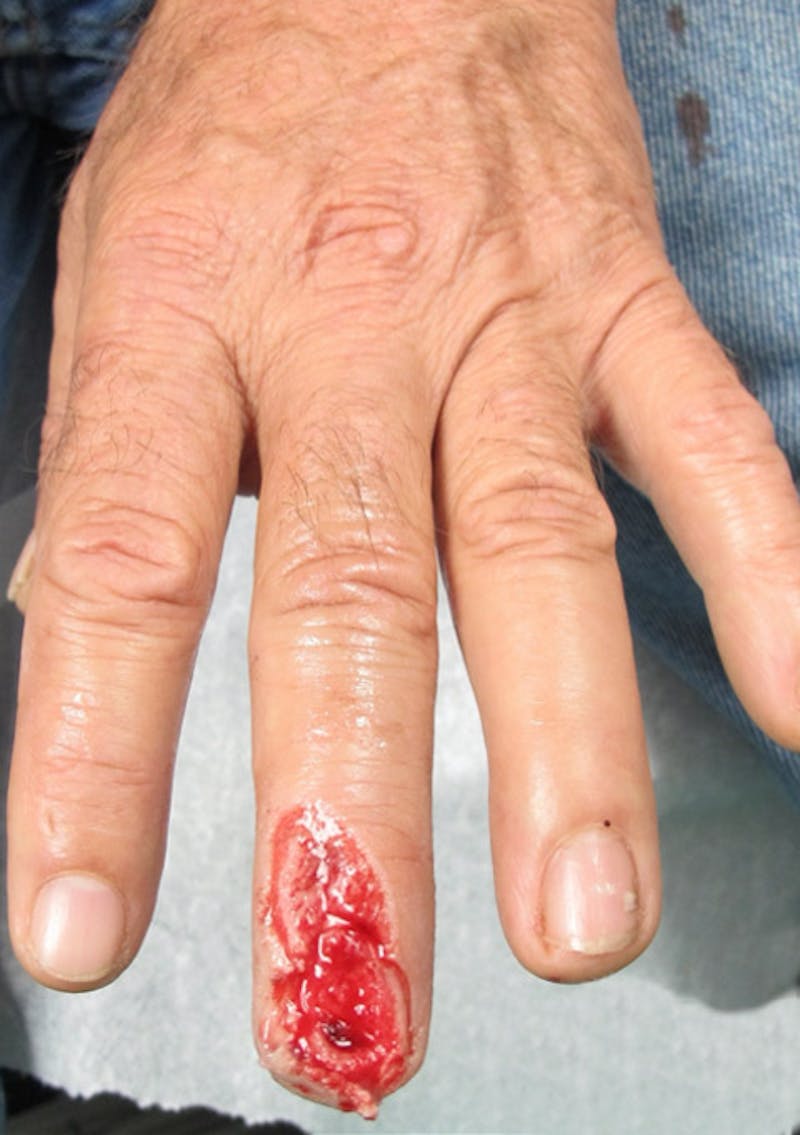 Hand Repair/Reconstruction Before & After Gallery - Patient 122909302 - Image 1