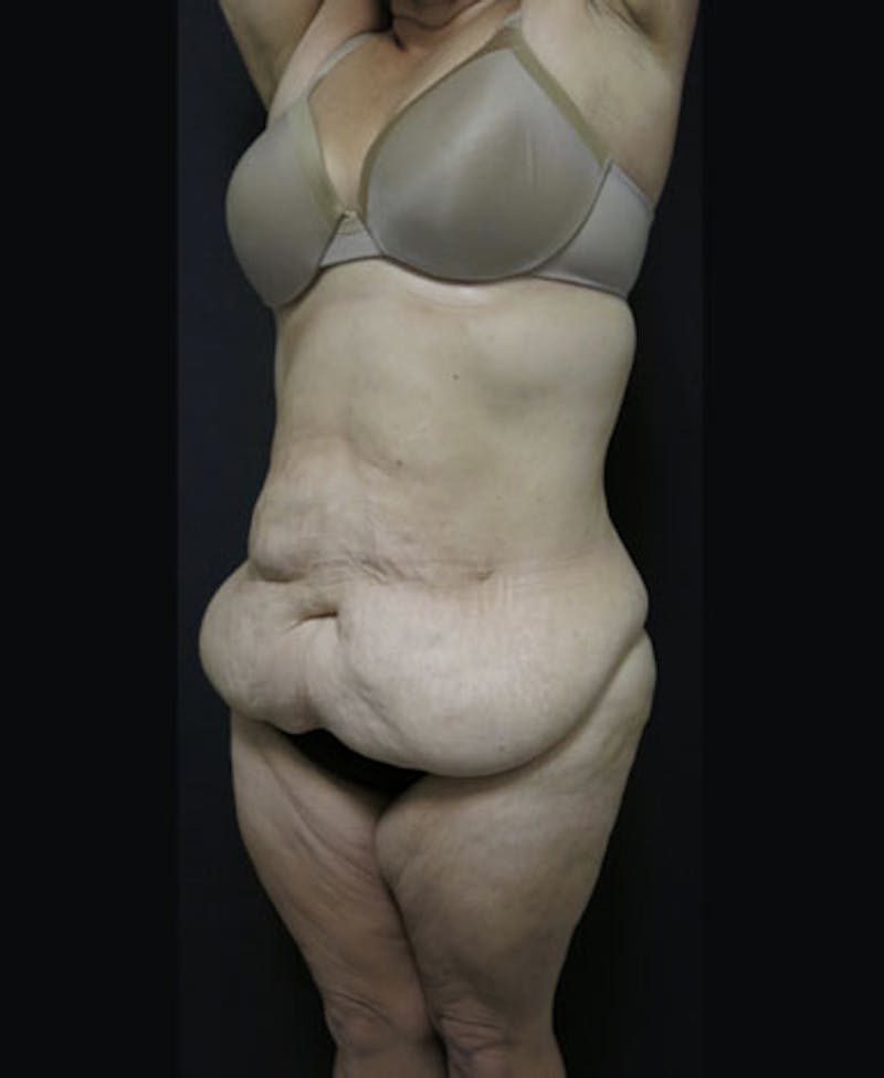 Lower Body Lift Before & After Gallery - Patient 163664 - Image 5