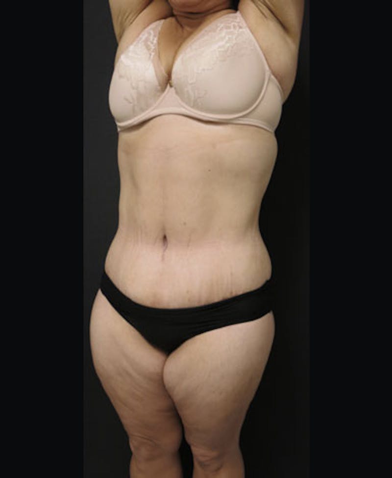 Lower Body Lift Before & After Gallery - Patient 122931146 - Image 6