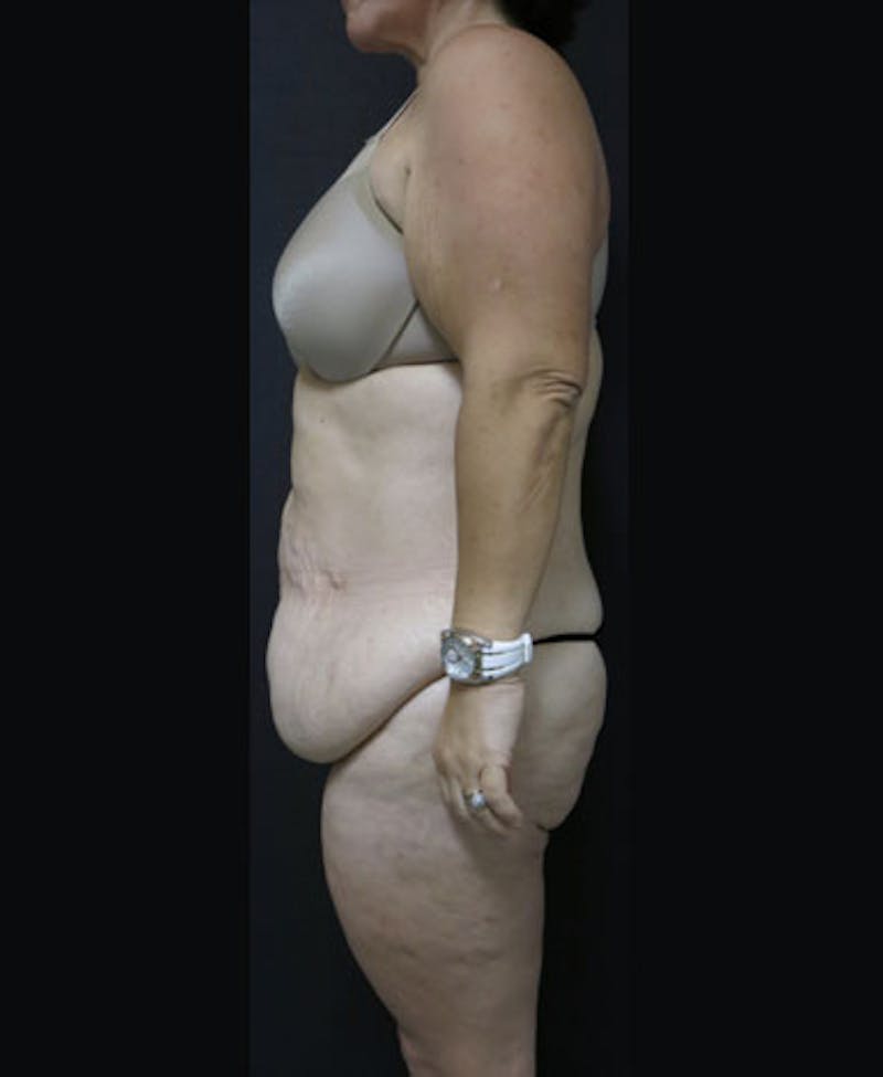 Lower Body Lift Before & After Gallery - Patient 122931146 - Image 7