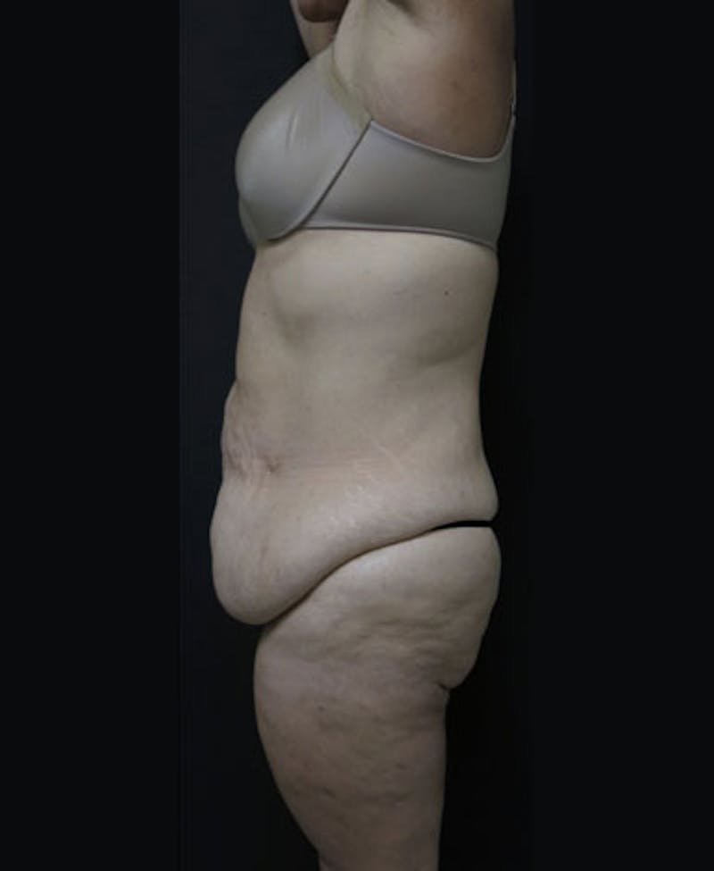 Lower Body Lift Before & After Gallery - Patient 163664 - Image 9