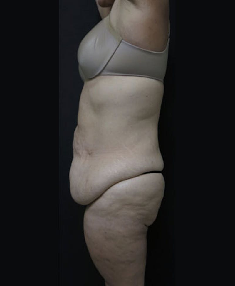 Lower Body Lift Before & After Gallery - Patient 122931146 - Image 9