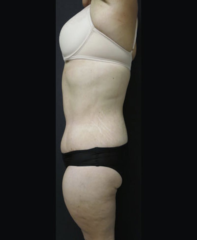 Lower Body Lift Before & After Gallery - Patient 122931146 - Image 10