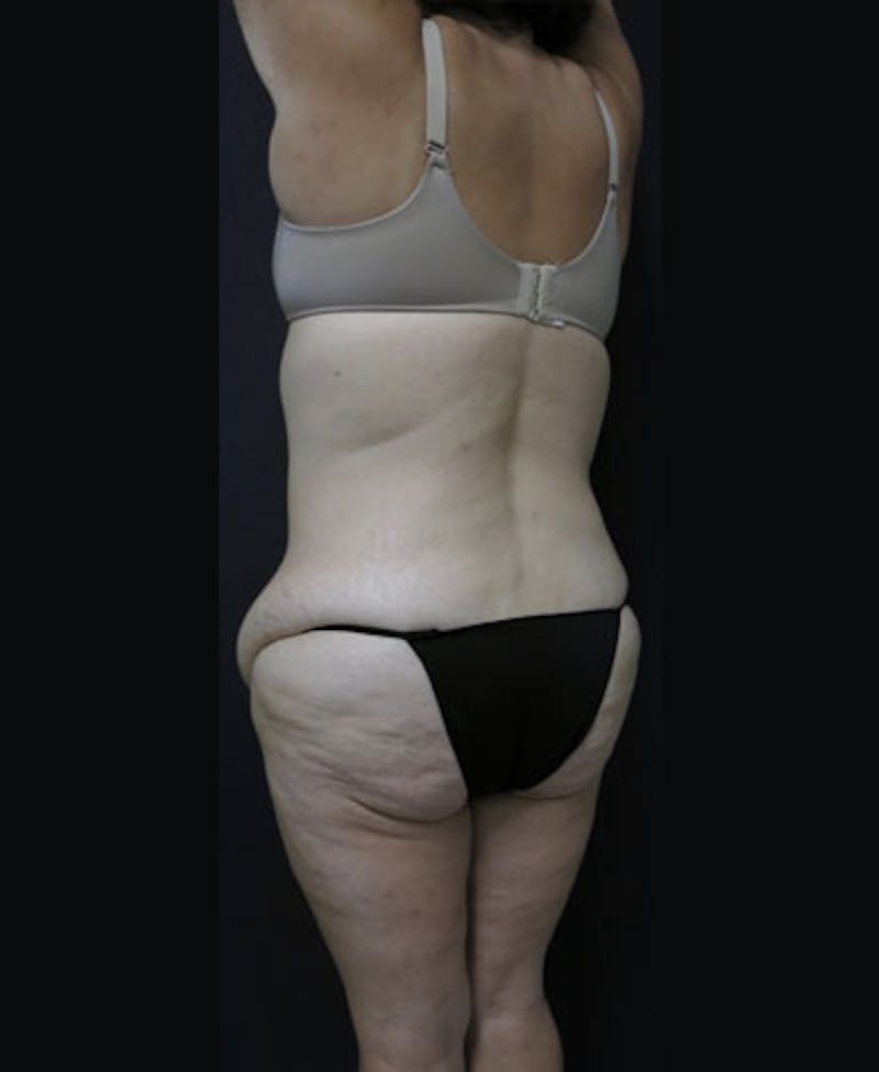 Lower Body Lift Before & After Gallery - Patient 122931146 - Image 11