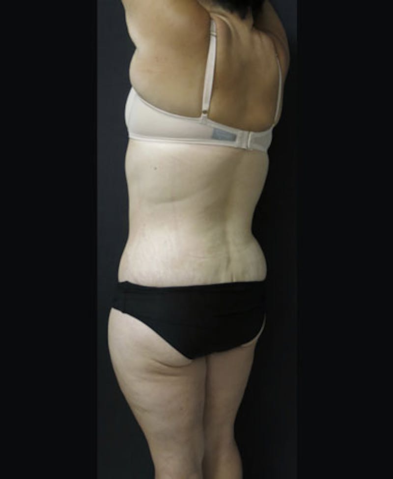 Lower Body Lift Before & After Gallery - Patient 163664 - Image 12