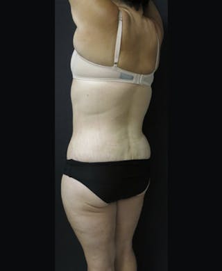 Lower Body Lift Before & After Gallery - Patient 122931146 - Image 12