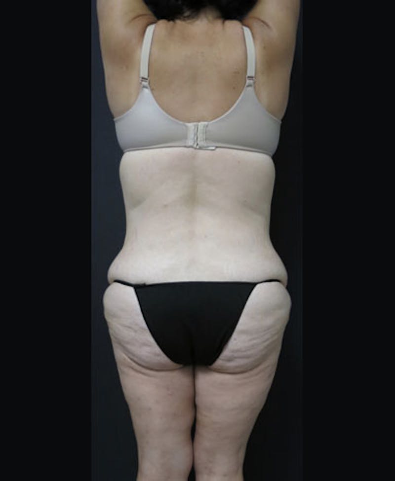 Lower Body Lift Before & After Gallery - Patient 122931146 - Image 13