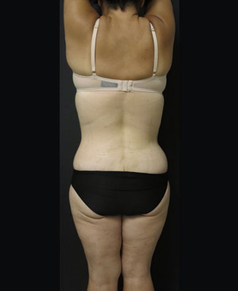 Lower Body Lift Before & After Gallery - Patient 122931146 - Image 14