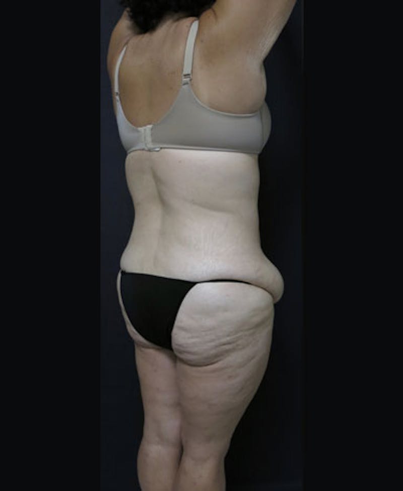 Lower Body Lift Before & After Gallery - Patient 122931146 - Image 15