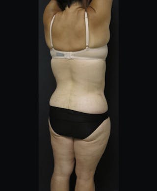 Lower Body Lift Before & After Gallery - Patient 122931146 - Image 16