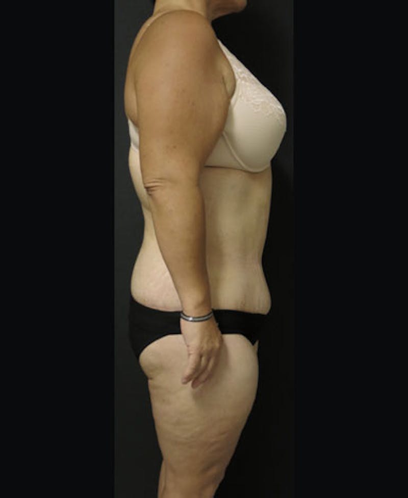Lower Body Lift Before & After Gallery - Patient 122931146 - Image 18