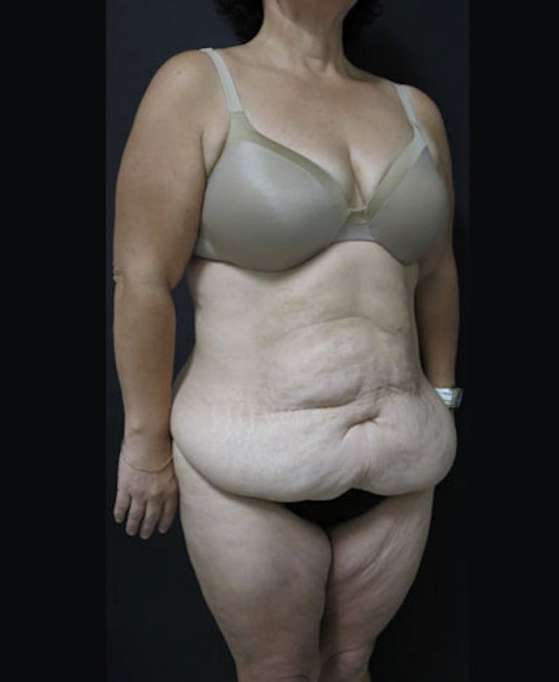 Lower Body Lift Before & After Gallery - Patient 163664 - Image 19