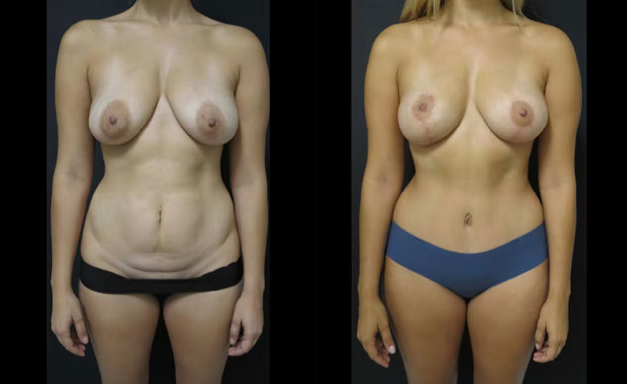 Extended Tummy Tuck