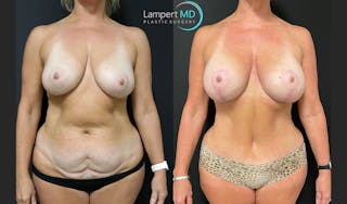 Tummy Tuck Before & After Gallery - Patient 123087301 - Image 1