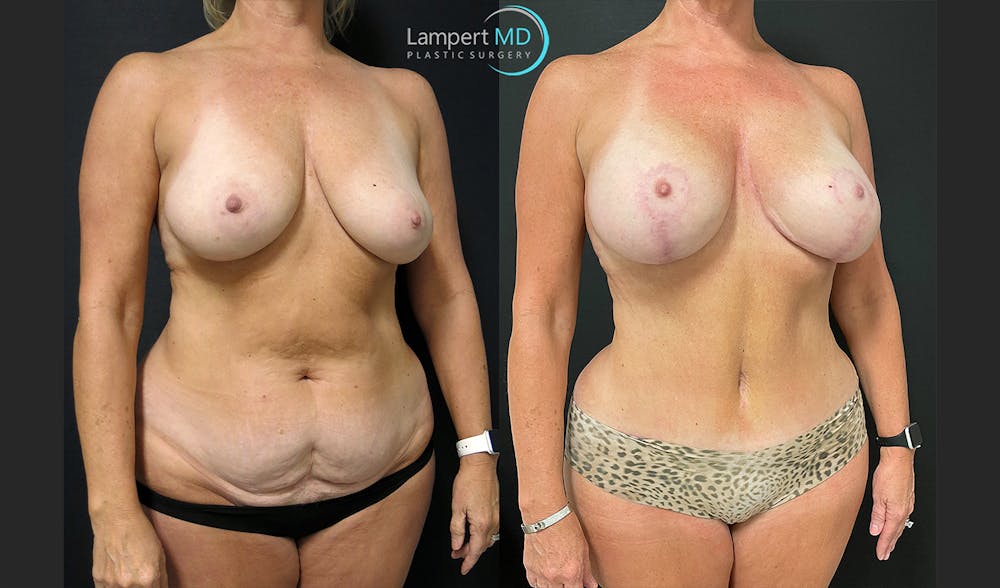 Tummy Tuck Before & After Gallery - Patient 123087301 - Image 2