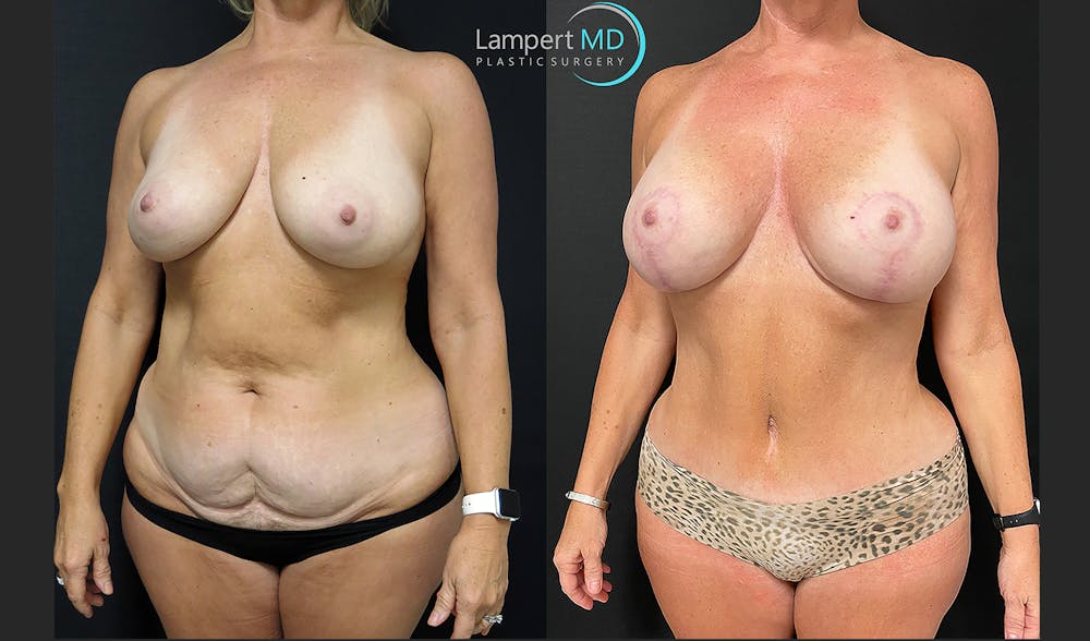Mommy Makeover Before & After Gallery - Patient 143575967 - Image 3