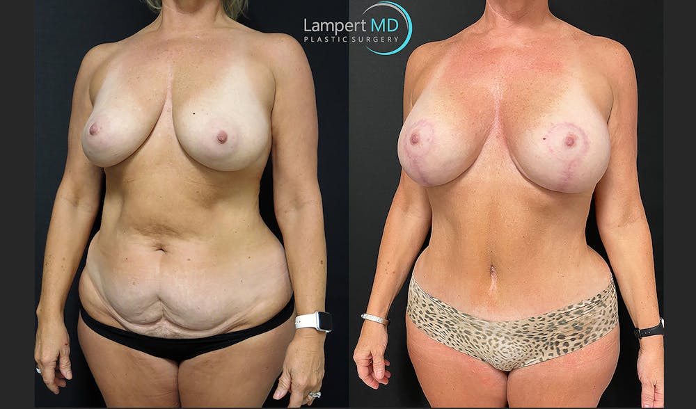 Tummy Tuck Before & After Gallery - Patient 123087301 - Image 3